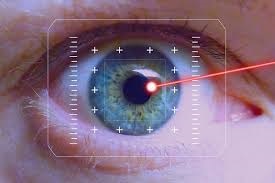 Lasik chirurgie réfractive